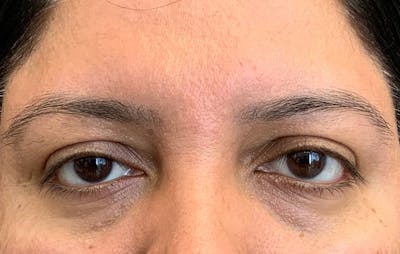 Fillers Before & After Gallery - Patient 359791 - Image 1