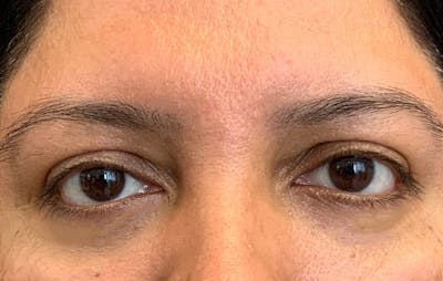 Fillers Before & After Gallery - Patient 359791 - Image 2