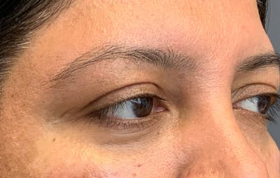 Fillers Before & After Gallery - Patient 359791 - Image 4