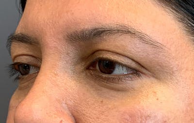 Fillers Before & After Gallery - Patient 359791 - Image 6