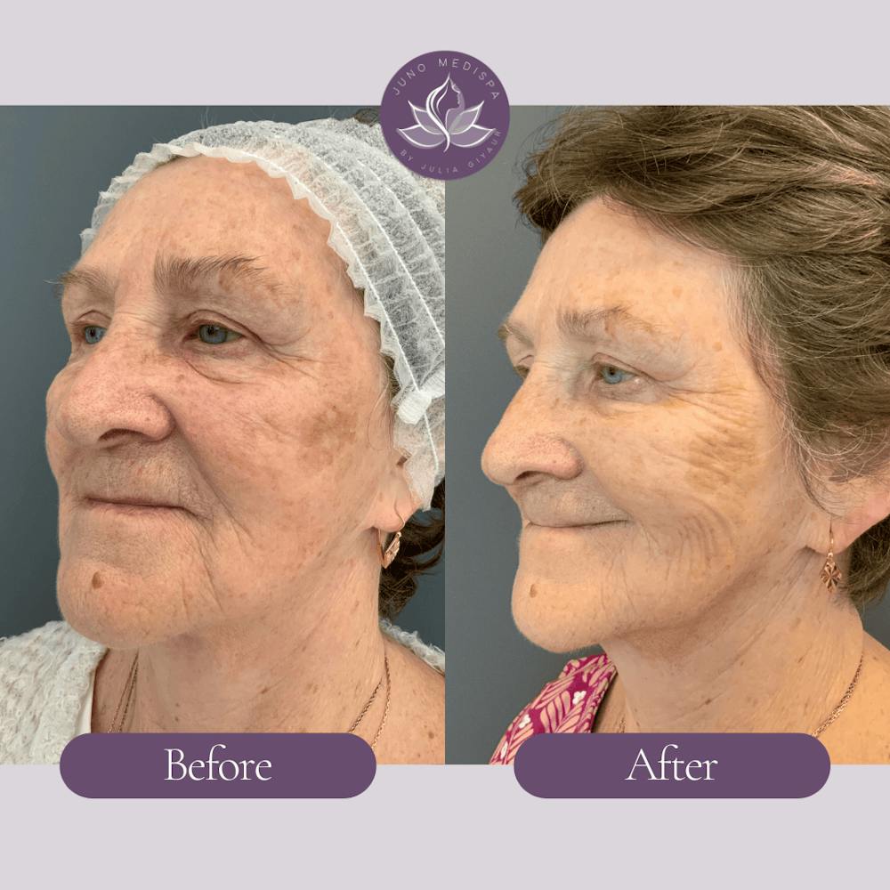 Laser Rejuvenation Before & After Gallery - Patient 461227 - Image 2