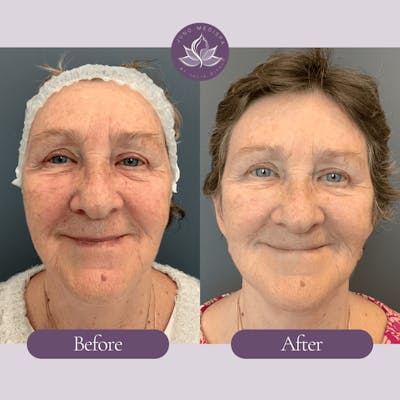 Laser Rejuvenation Before & After Gallery - Patient 461227 - Image 1