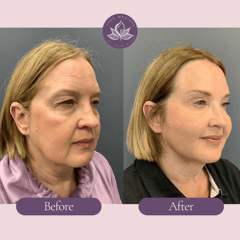 Thread Lift Before & After Gallery - Patient 304851 - Image 2