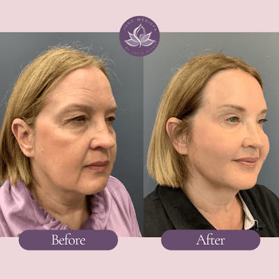 Thread Lift Before & After Gallery - Patient 304851 - Image 2