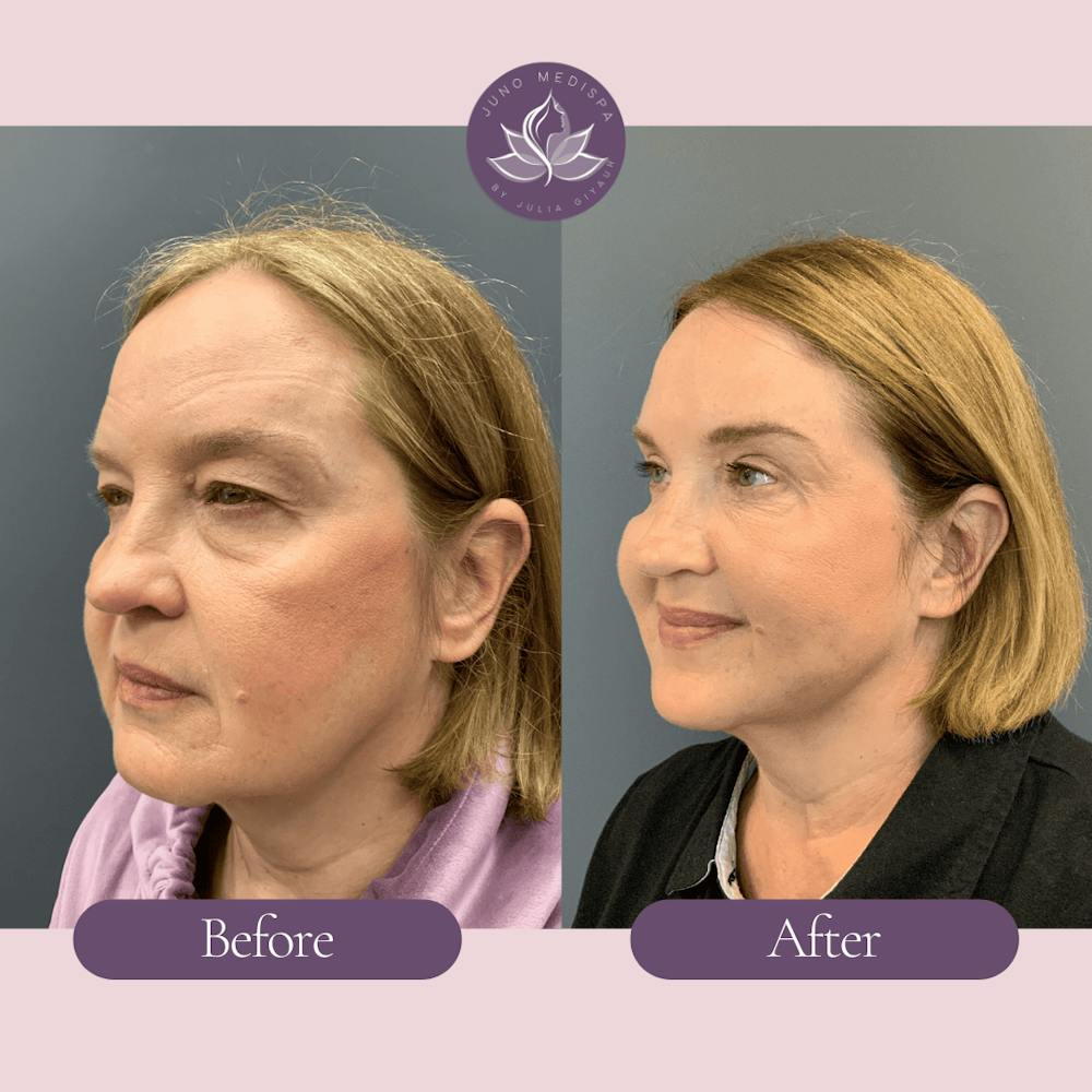 Thread Lift Before & After Gallery - Patient 304851 - Image 3