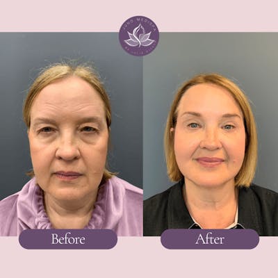 Thread Lift Before & After Gallery - Patient 304851 - Image 1