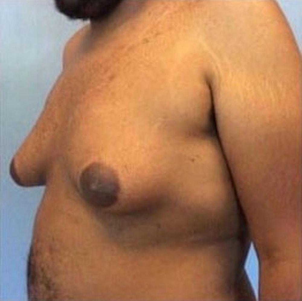 Male Breast Reduction Gallery - Patient 13947213 - Image 1