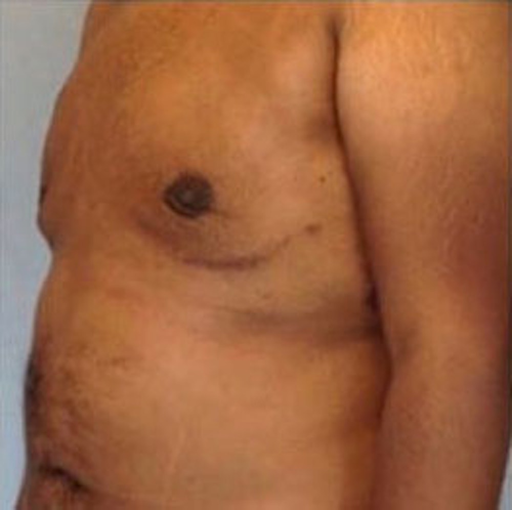 Male Breast Reduction Before & After Gallery - Patient 13947213 - Image 2