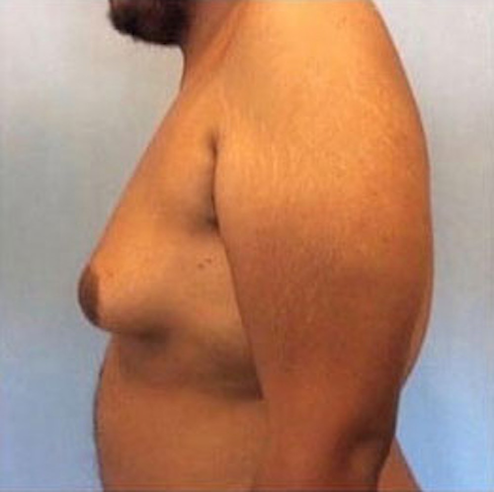 Male Breast Reduction Before & After Gallery - Patient 13947213 - Image 3