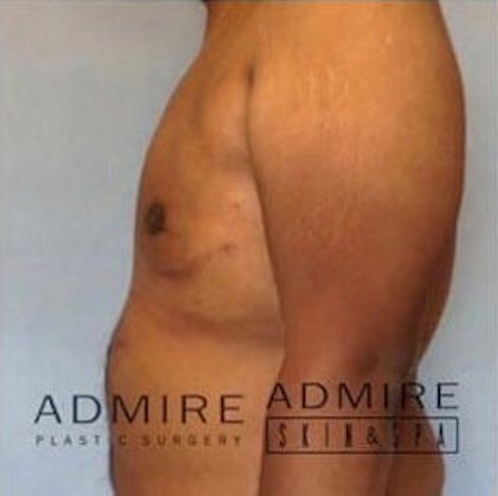 Male Breast Reduction Before & After Gallery - Patient 13947213 - Image 4