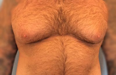 Male Breast Reduction Before & After Gallery - Patient 13947214 - Image 1