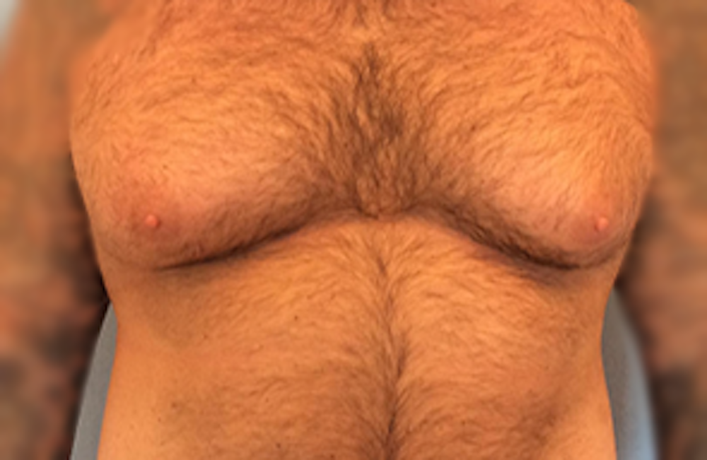 Male Breast Reduction Gallery - Patient 13947214 - Image 1