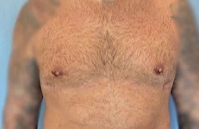 Male Breast Reduction Before & After Gallery - Patient 13947214 - Image 2