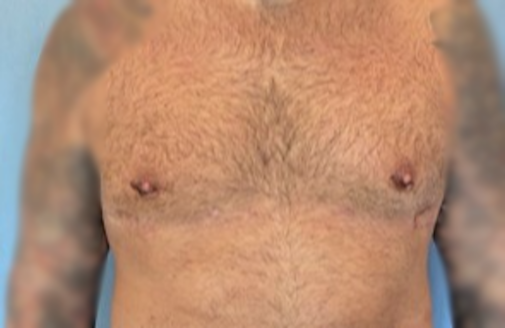 Male Breast Reduction Before & After Gallery - Patient 13947214 - Image 2