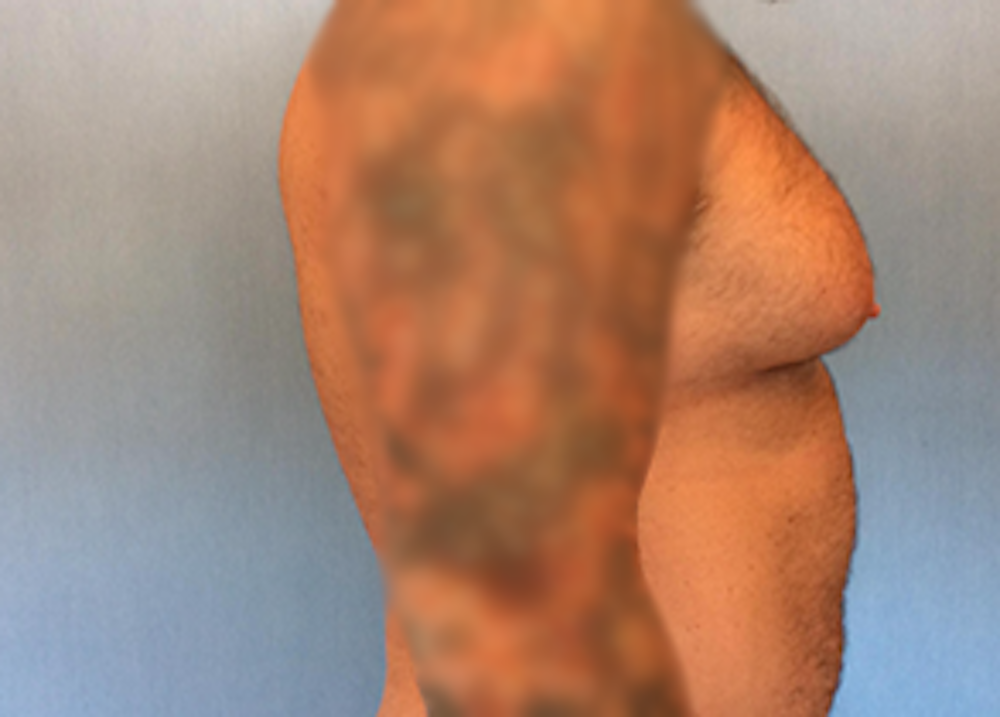 Male Breast Reduction Before & After Gallery - Patient 13947214 - Image 3