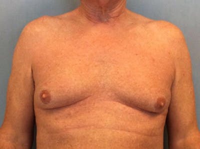 Male Breast Reduction Before & After Gallery - Patient 13947215 - Image 1