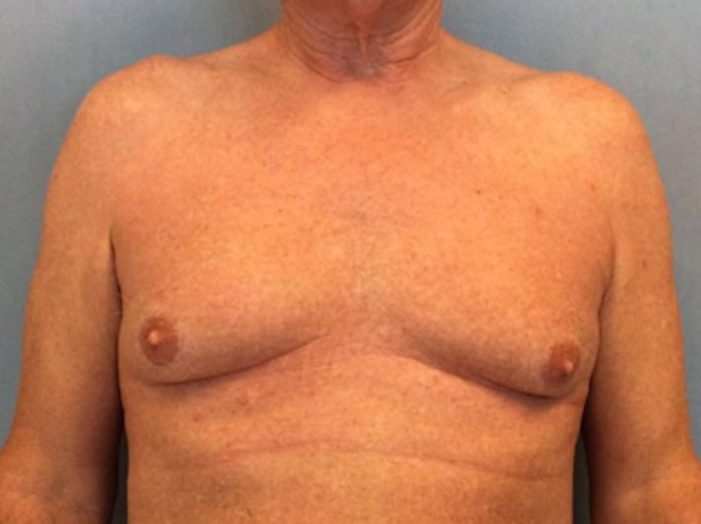Male Breast Reduction Before & After Gallery - Patient 13947215 - Image 1