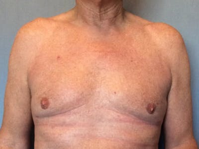Male Breast Reduction Before & After Gallery - Patient 13947215 - Image 2