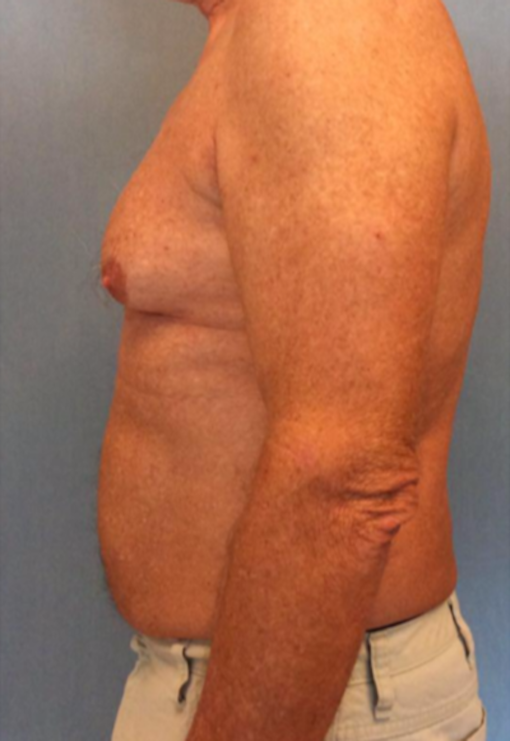 Male Breast Reduction Before & After Gallery - Patient 13947215 - Image 3