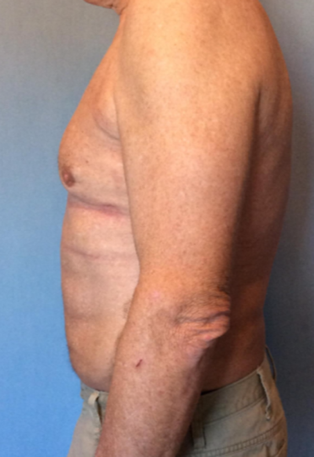 Male Breast Reduction Before & After Gallery - Patient 13947215 - Image 4