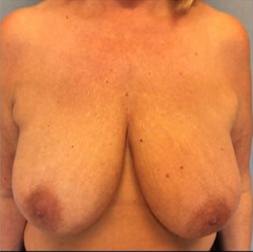 Breast Reduction Before & After Gallery - Patient 13947202 - Image 1
