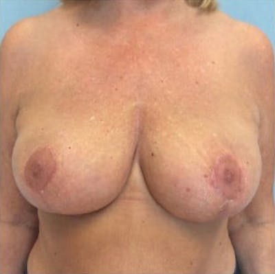 Breast Reduction Before & After Gallery - Patient 13947202 - Image 2