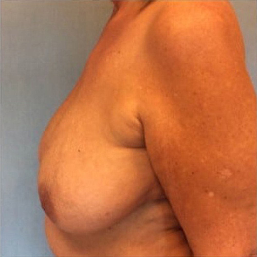 Breast Reduction Before & After Gallery - Patient 13947202 - Image 3