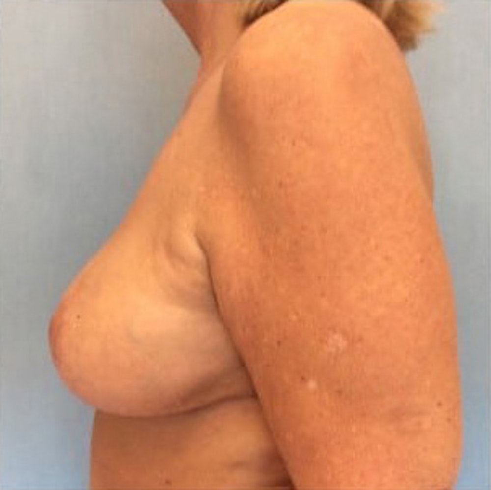 Breast Reduction Before & After Gallery - Patient 13947202 - Image 4