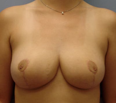 Breast Reduction Before & After Gallery - Patient 13947204 - Image 2