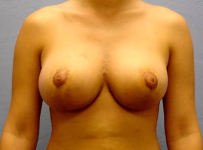 Breast Reduction Before & After Gallery - Patient 13947205 - Image 2