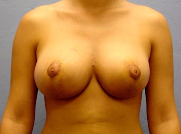 Breast Reduction Gallery - Patient 13947205 - Image 2