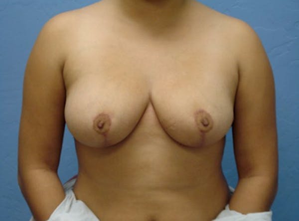 Breast Reduction Gallery - Patient 13947206 - Image 2