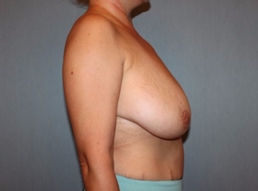 Breast Reduction Before & After Gallery - Patient 13947207 - Image 3
