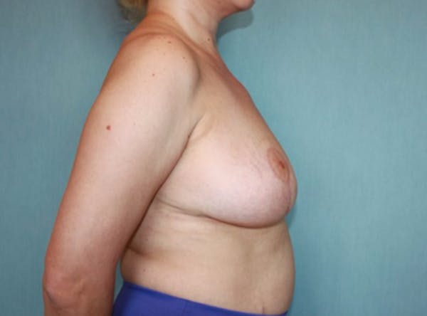 Breast Reduction Gallery - Patient 13947207 - Image 4