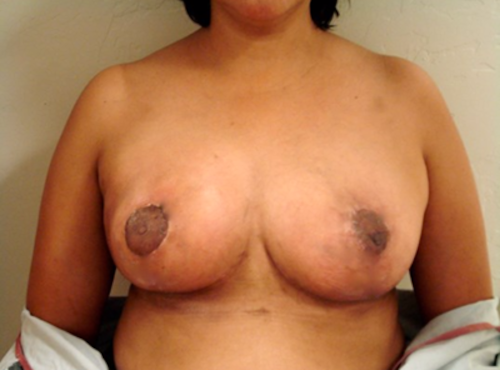 Breast Reduction Before & After Gallery - Patient 13947208 - Image 2