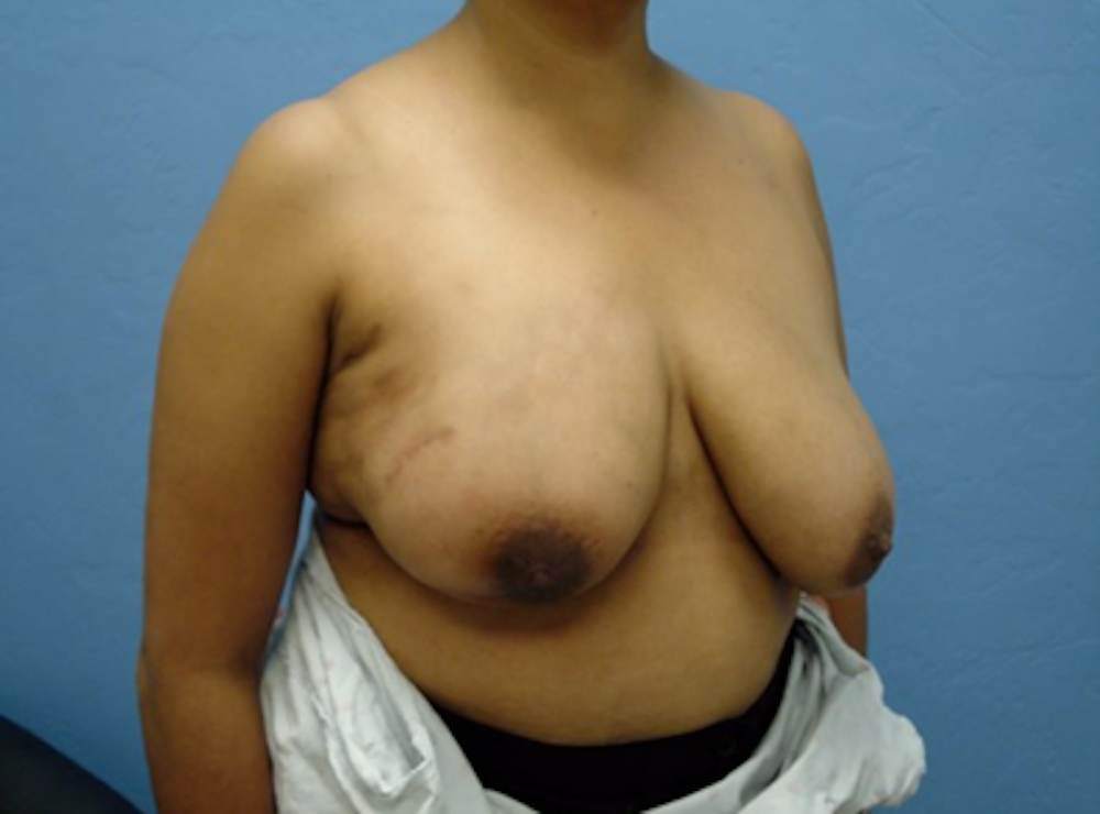 Breast Reduction Before & After Gallery - Patient 13947208 - Image 3