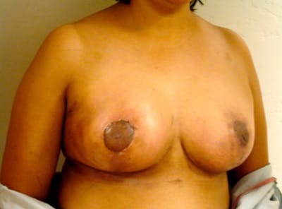 Breast Reduction Before & After Gallery - Patient 13947208 - Image 4