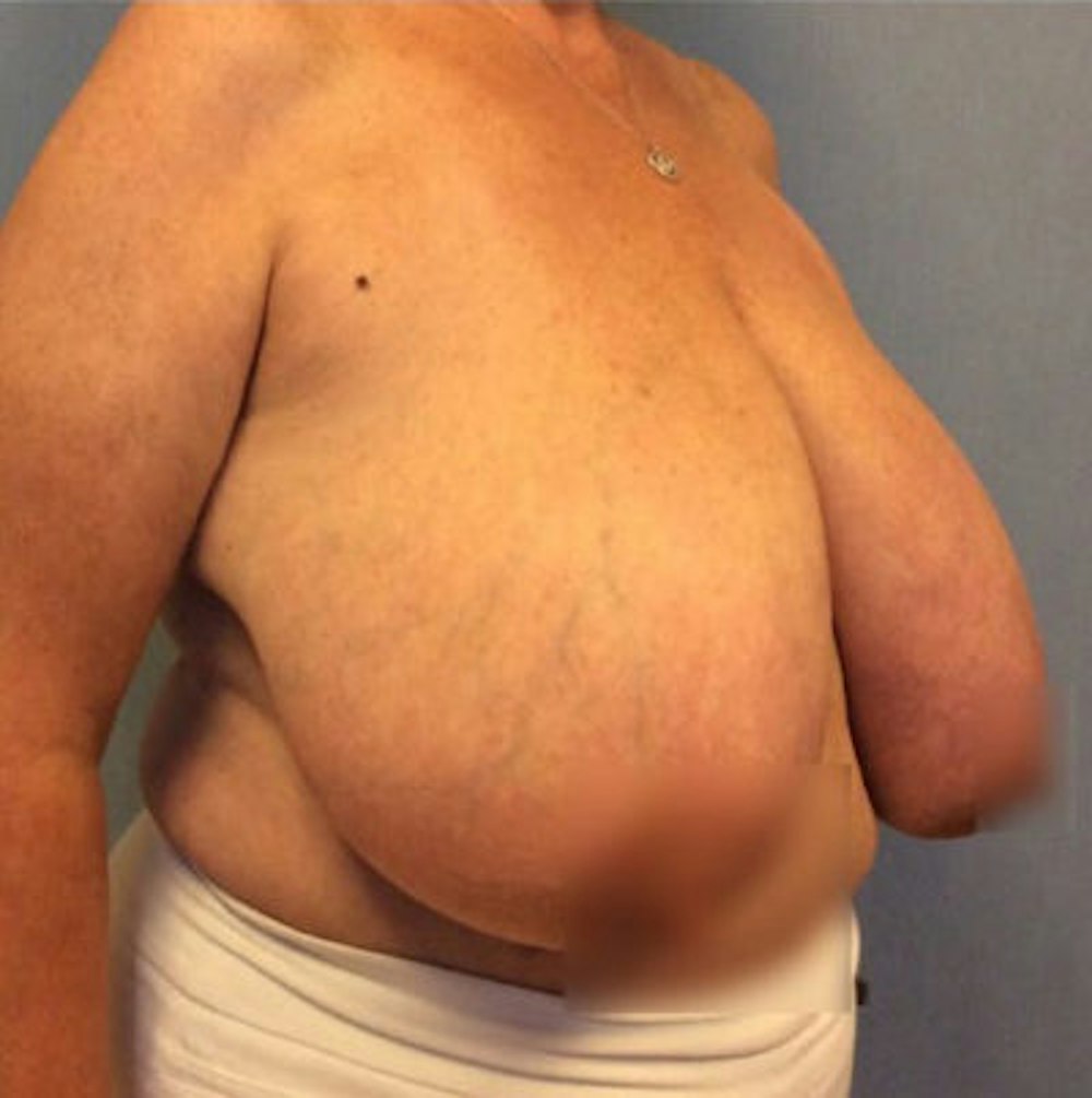 Breast Reduction Gallery - Patient 13947209 - Image 1