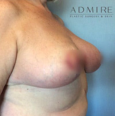 Breast Reduction Before & After Gallery - Patient 13947209 - Image 2