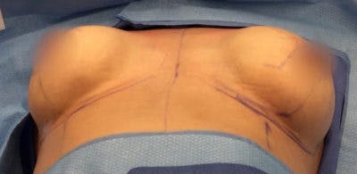 Breast Implant Revision Before & After Gallery - Patient 13947231 - Image 1