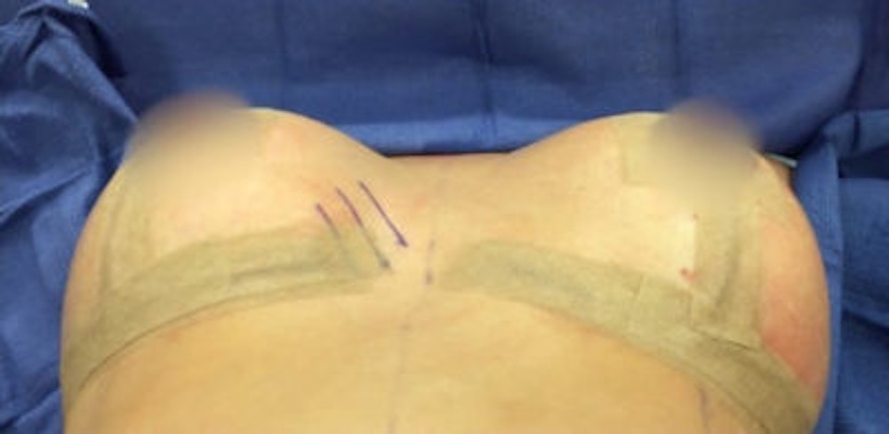 Breast Implant Revision Before & After Gallery - Patient 13947231 - Image 2