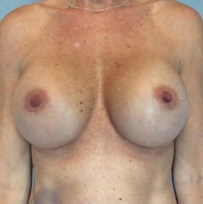 Breast Implant Revision Before & After Gallery - Patient 13947232 - Image 2