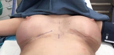 Breast Implant Revision Before & After Gallery - Patient 13947233 - Image 2