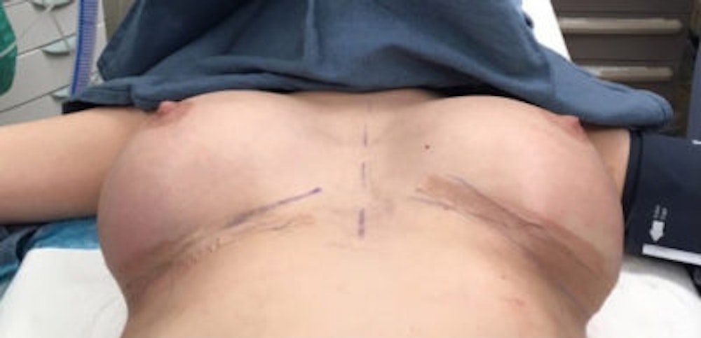 Breast Implant Revision Before & After Gallery - Patient 13947233 - Image 2