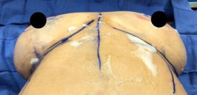 Breast Implant Revision Before & After Gallery - Patient 13947234 - Image 1