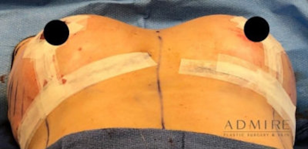 Breast Implant Revision Before & After Gallery - Patient 13947234 - Image 2