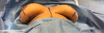 Breast Implant Revision Before & After Gallery - Patient 13947235 - Image 1