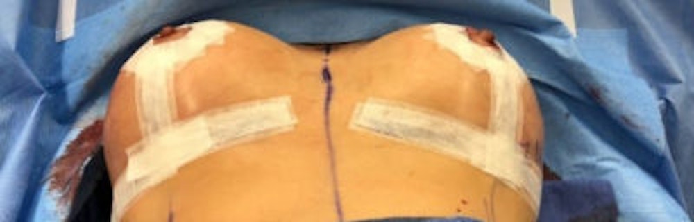 Breast Implant Revision Gallery - Patient 13947235 - Image 2