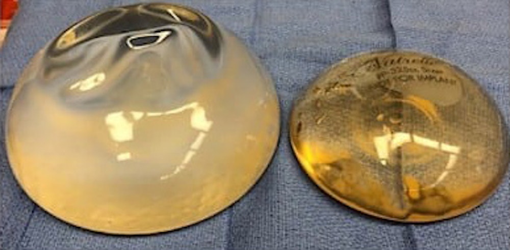 Breast Implant Revision Gallery - Patient 13947235 - Image 3
