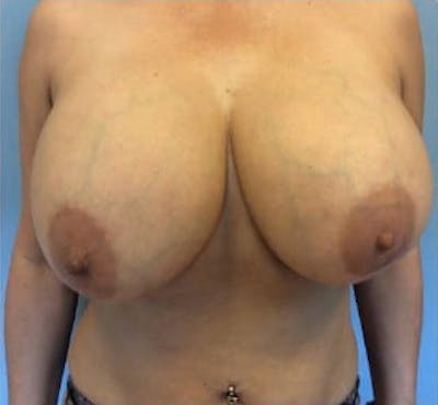 Breast Implant Revision Before & After Gallery - Patient 13947236 - Image 1